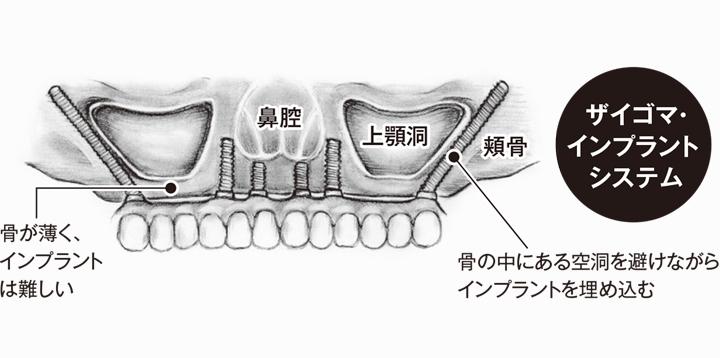 ザイゴマインプラントシステム
