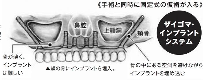 ザイゴマインプラント