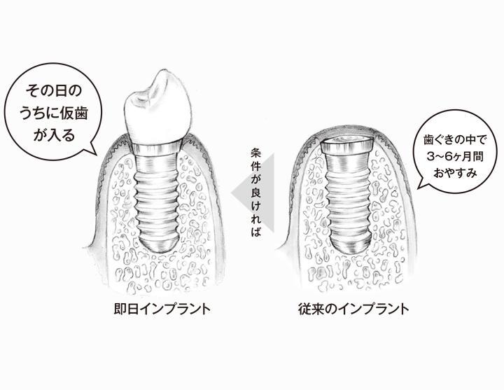 これまでは仮歯まで何ヶ月もかかることも