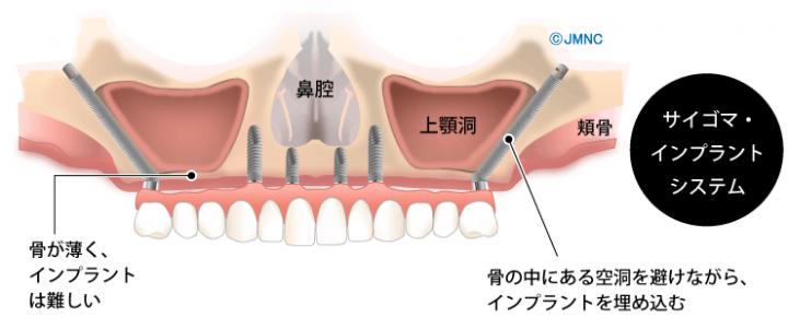 ザイゴマ・インプラントとは