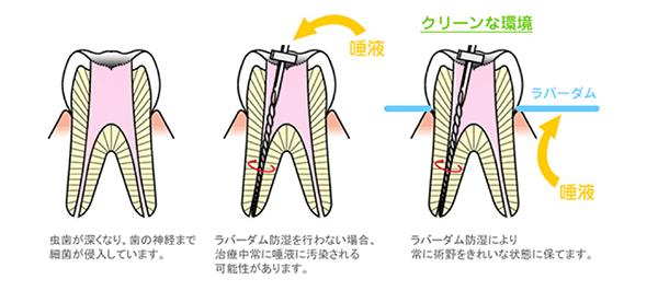 マイクロスコープを使った根管治療