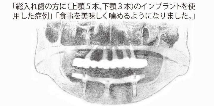 インプラントで睡眠時の無呼吸症候群が治る?