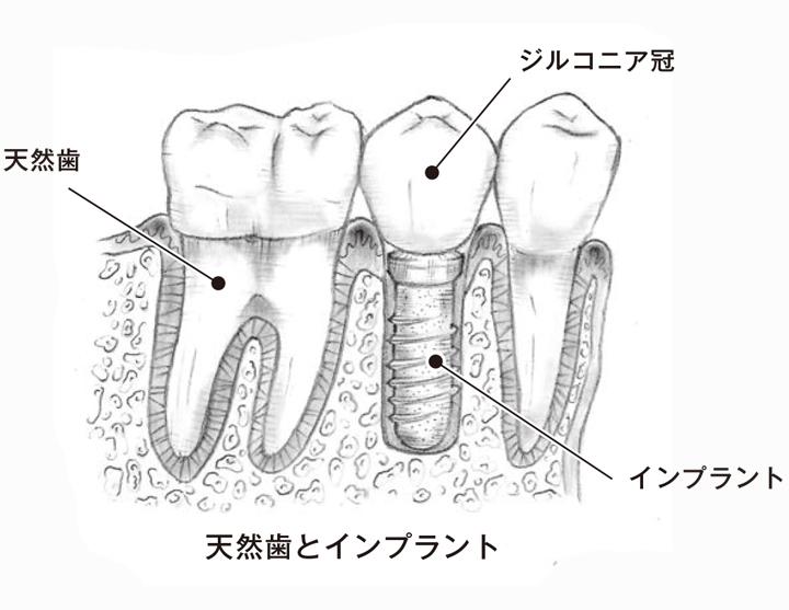 インプラントと ジルコニア冠