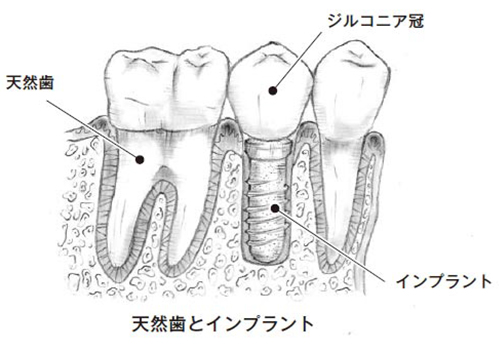 インプラントとジルコニア冠
