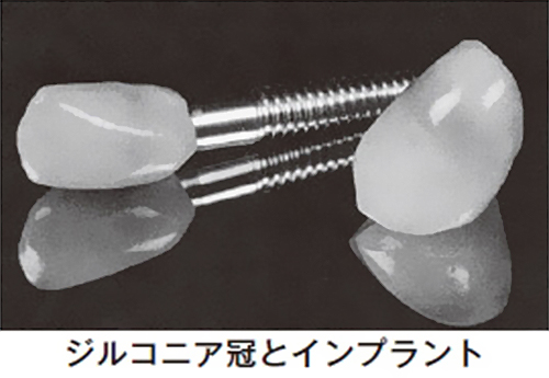 インプラントのベストパートナー