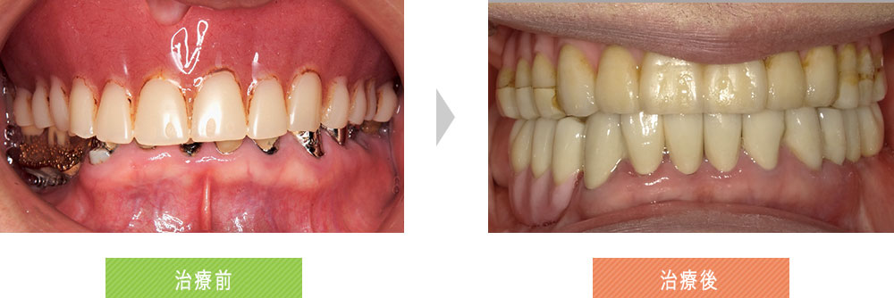 上顎の入れ歯が合わない
