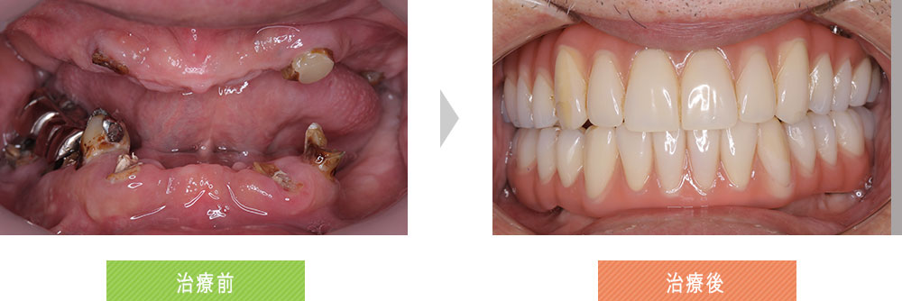 歯がなくてかめない