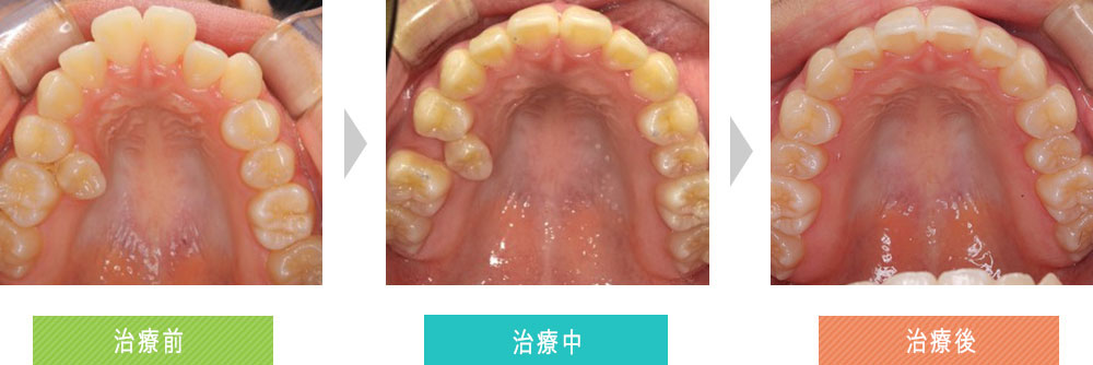 第三症例（上顎前突と叢生（ガタガタ）の改善）
