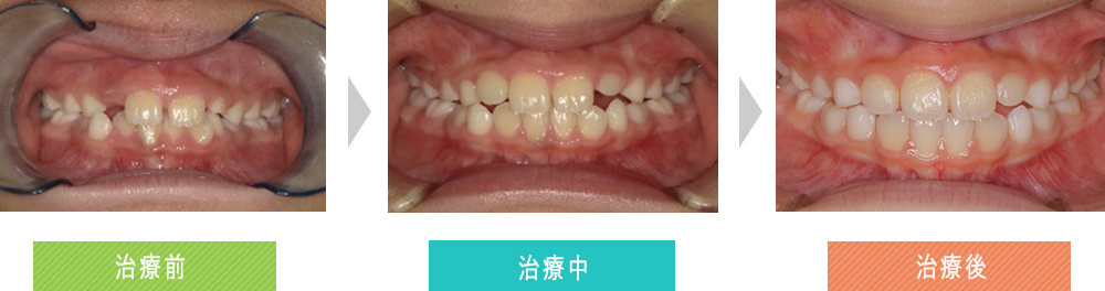 第四症例（第一期治療（オーバーバイトの改善））