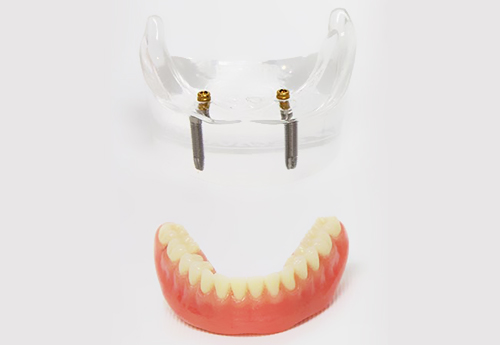 抜歯後はどの治療方法が良い！？インプラントとブリッジ・入れ歯の比較