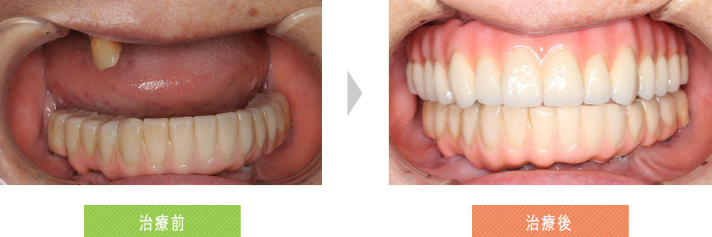 入れ歯がかめない
