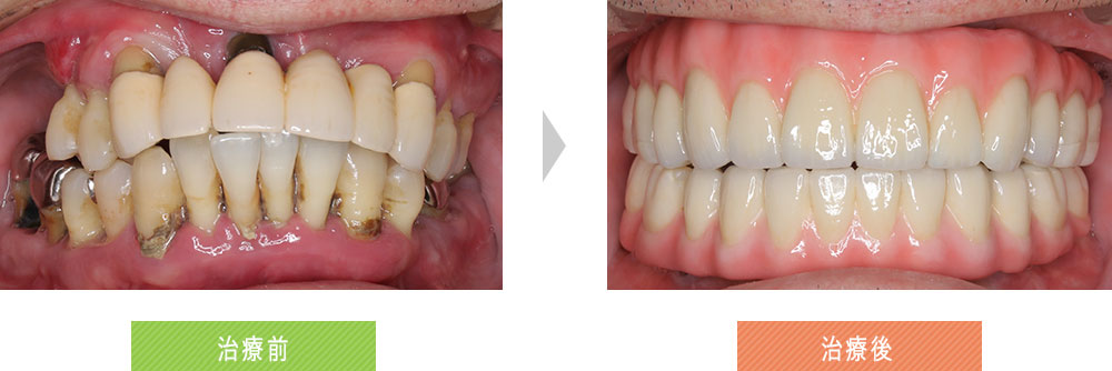 歯周病で歯がグラグラ