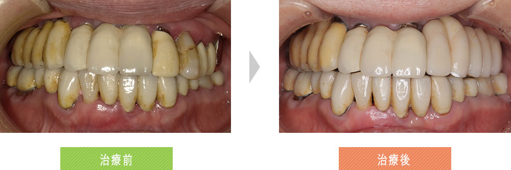 左上臼歯部の動揺