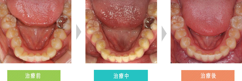 第三症例（上顎前突と叢生（ガタガタ）の改善）