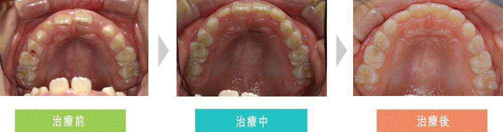 第四症例（第一期治療（オーバーバイトの改善））