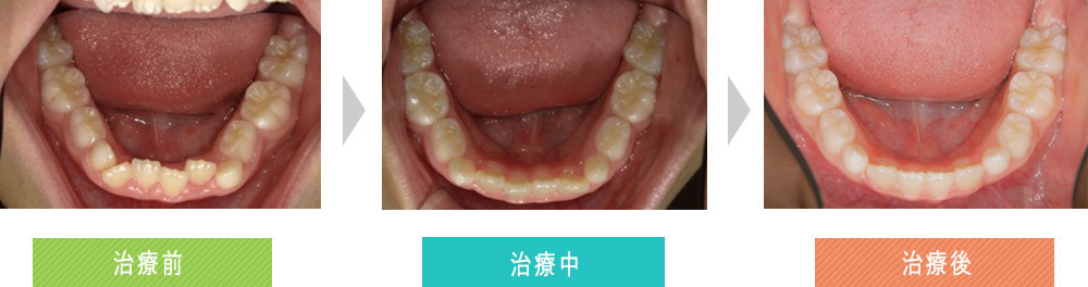 第四症例（第一期治療（オーバーバイトの改善））