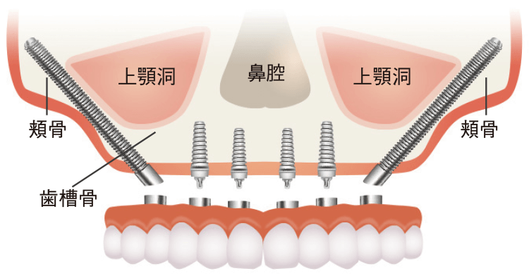 通常のインプラントと何が違う？