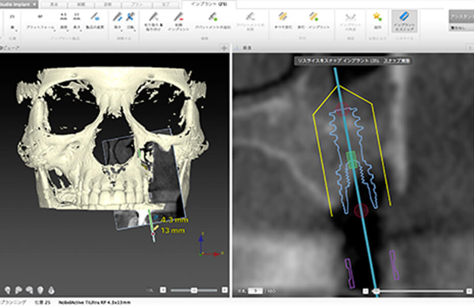 (図1)DTX Implant